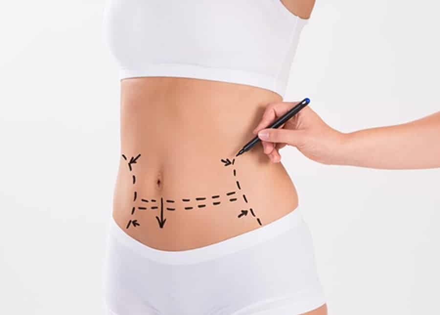 Cirugía de mini abdominoplastia