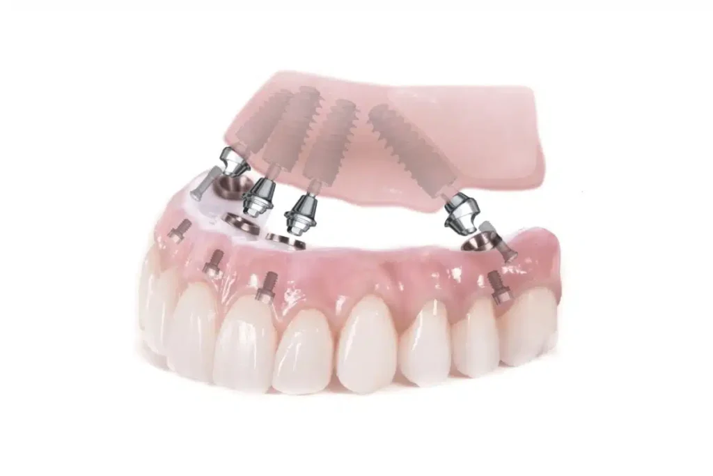 Implantes Dentales All-on-4 en Turquía