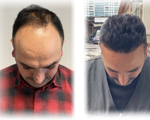 Trasplante Capilar Antes y Después