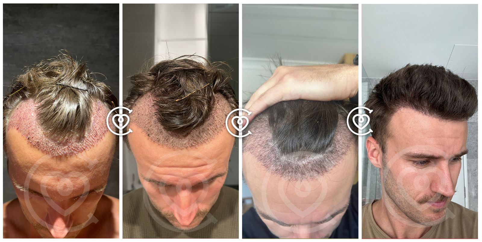 Trasplante Capilar DHI Implantación Directa del Cabello
