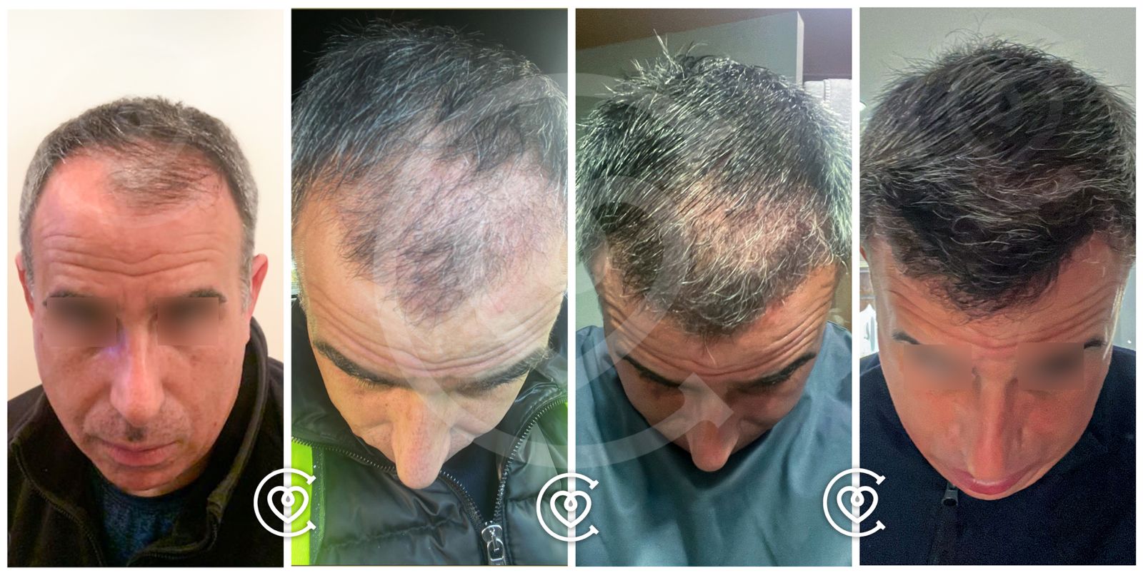 Trasplante Capilar FUE Extracción de Unidades Foliculares
