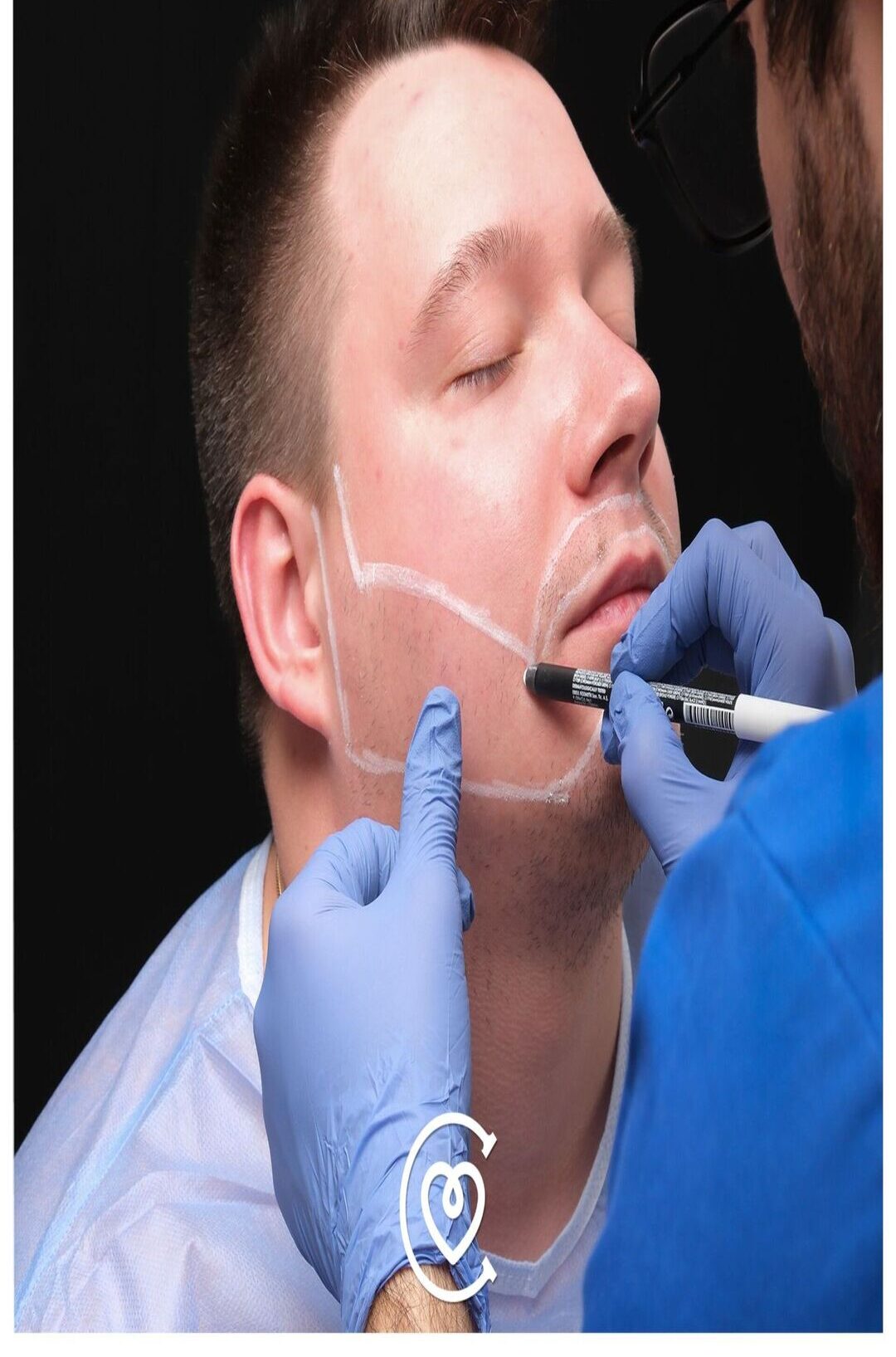 Trasplante de Barba y Cejas