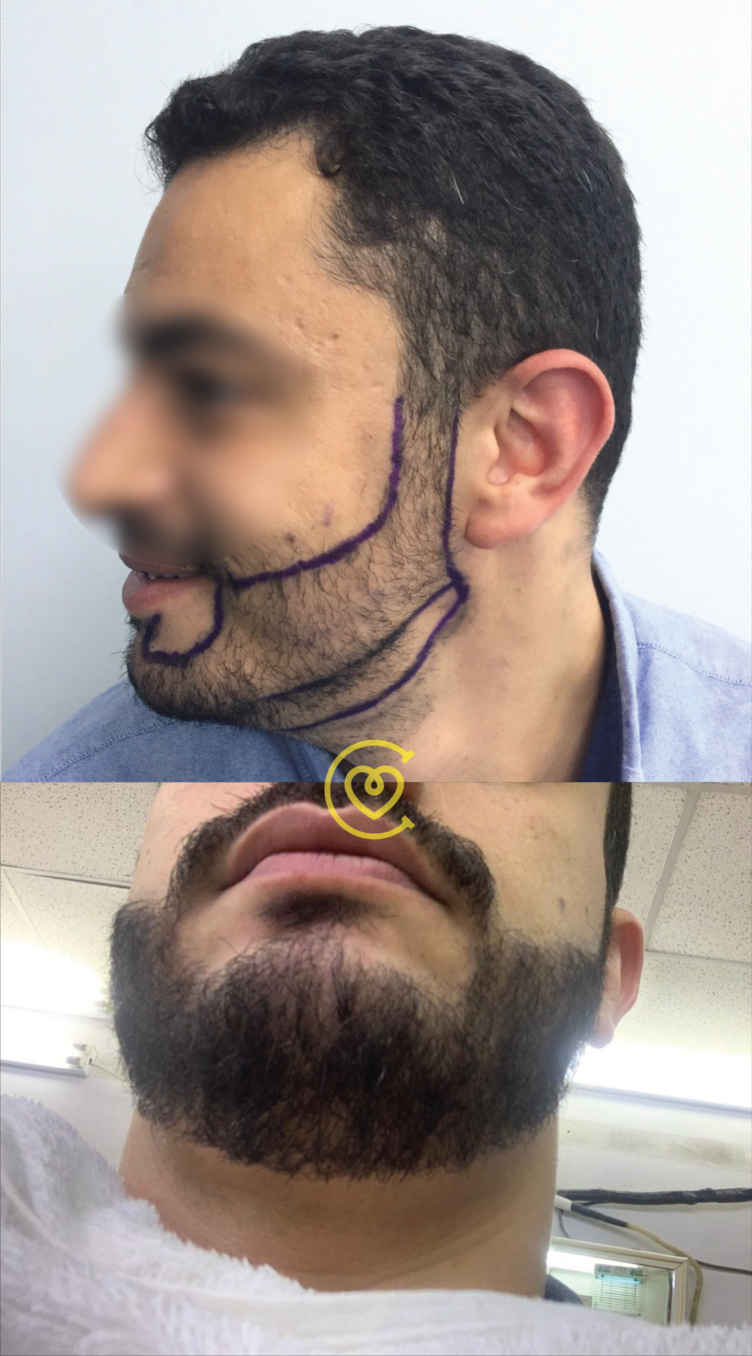 Trasplante de Barba y Cejas Antes y Después