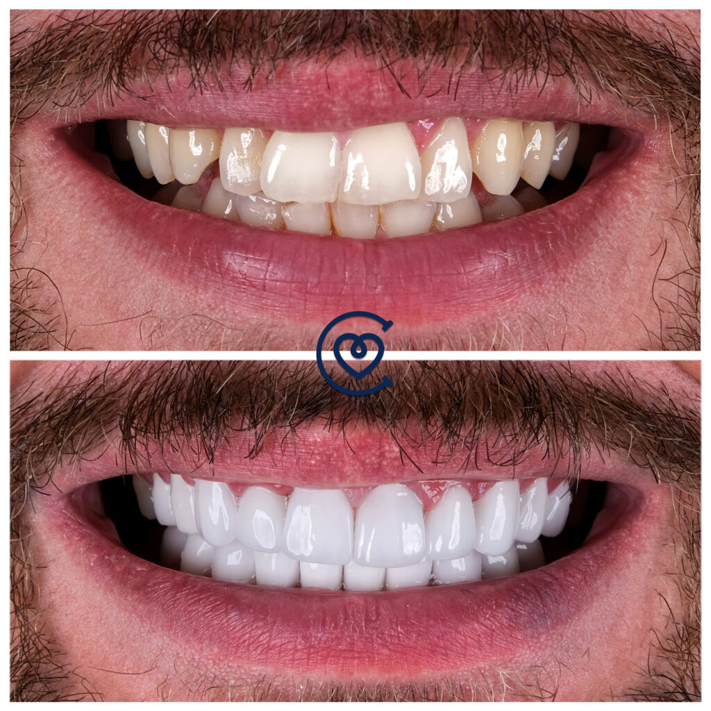 Coronas de zirconio, resultado antes y después