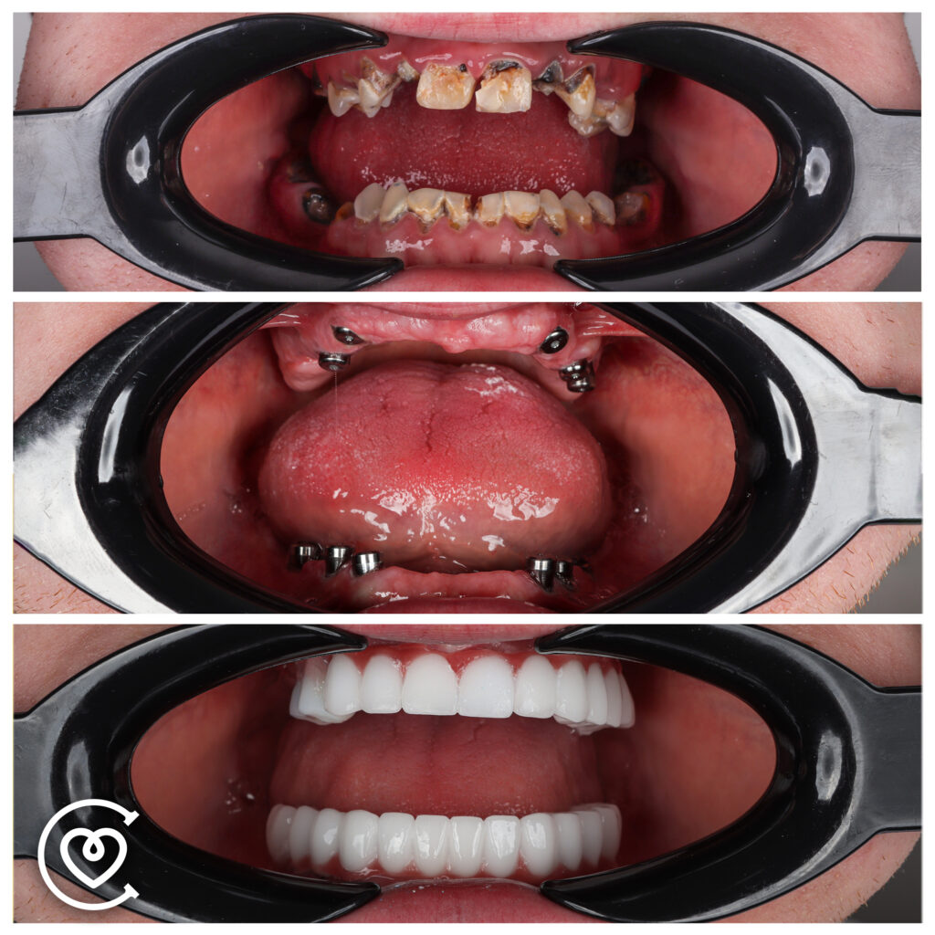 Implante dental all on 4 antes y después