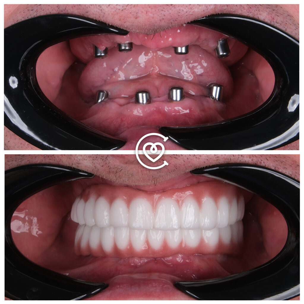 Implantes dentales antes y después resultado