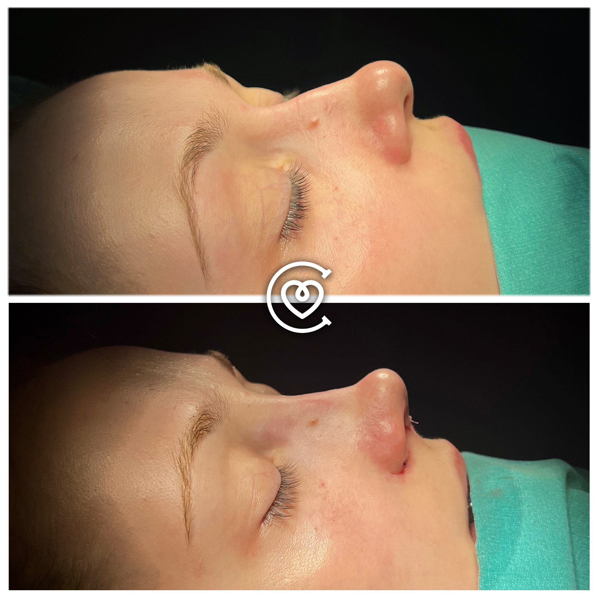 Testimonios de pacientes de rinoplastia
