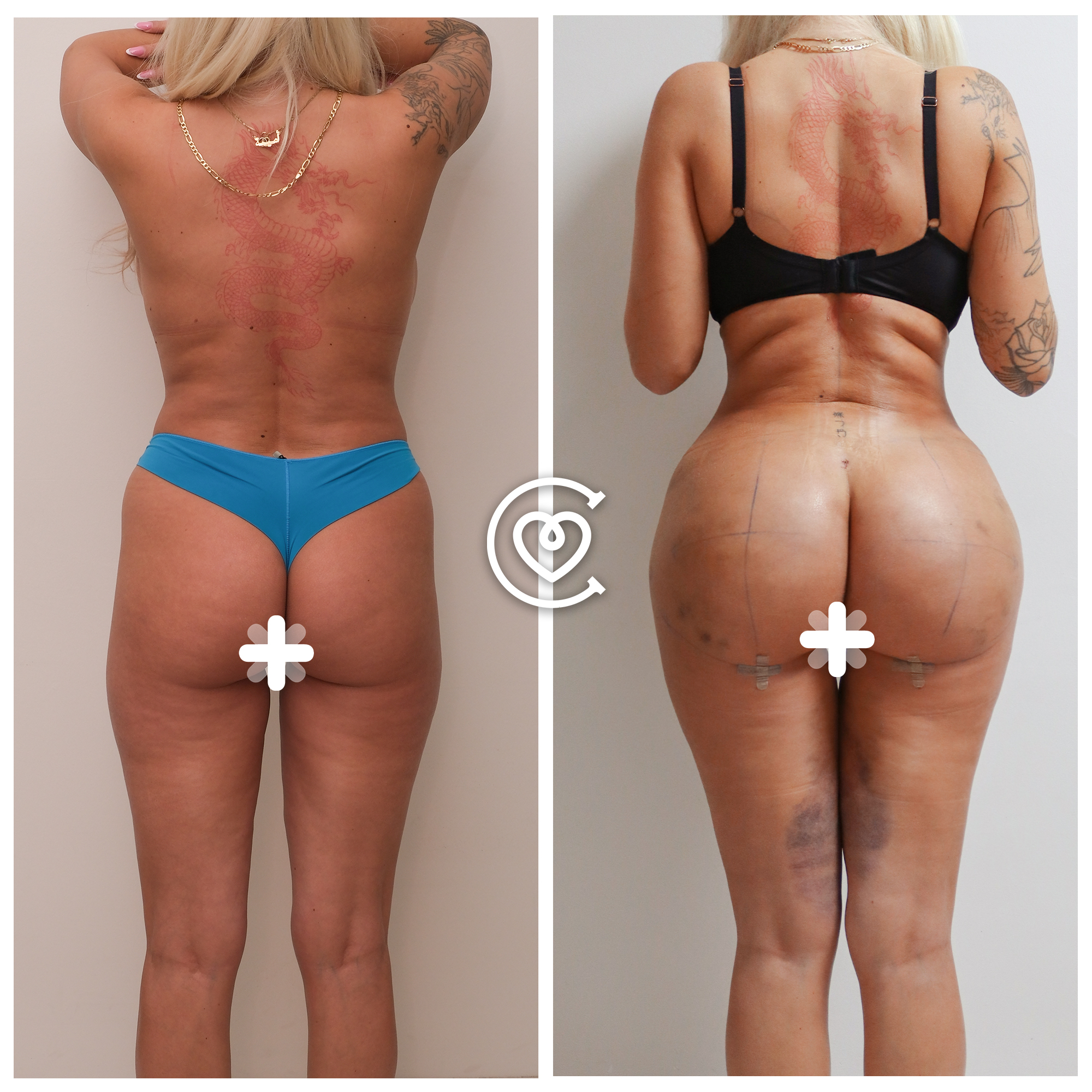 Testimonios de pacientes sobre liposucción