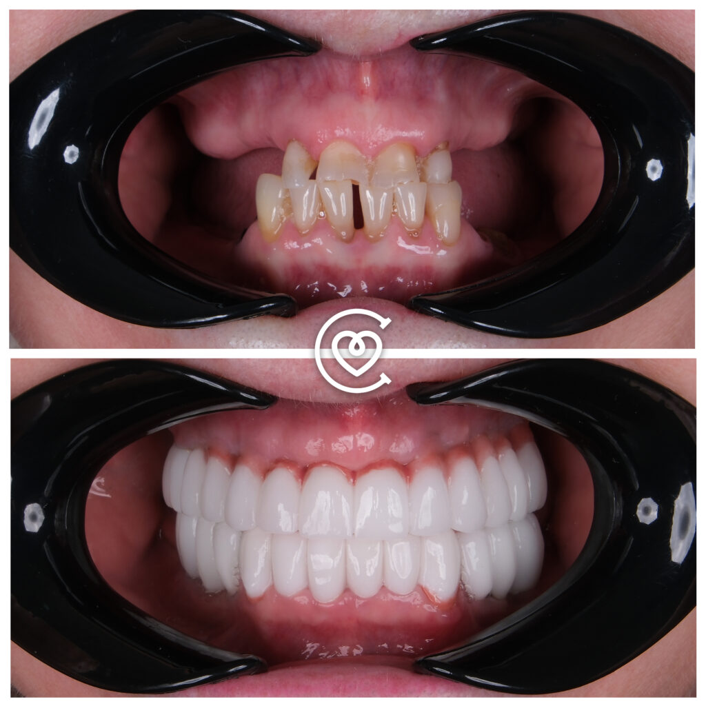 Tratamiento dental antes y después