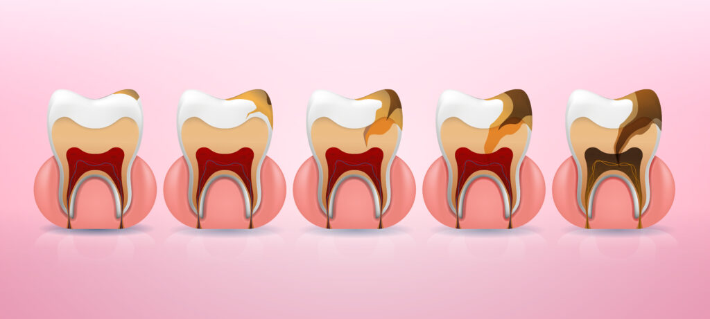 Empastes Dentales en Turquía