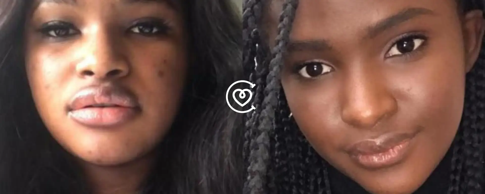 Queiloplastia antes y después