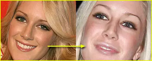 Reducción de labios Heidi Montag