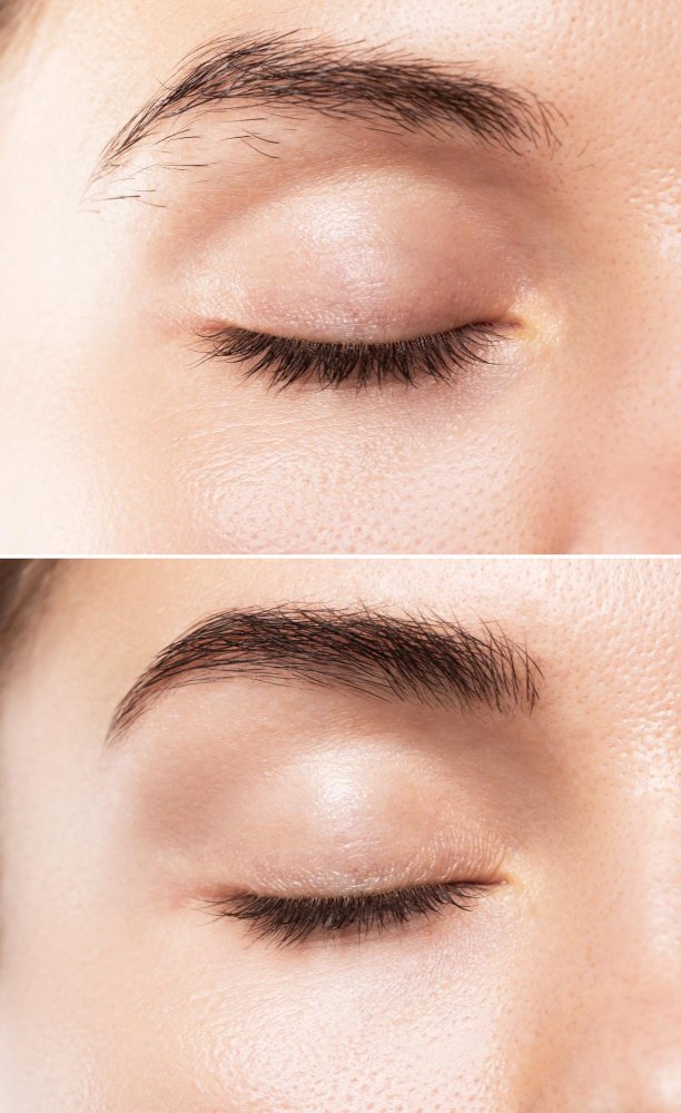 trasplante de cejas antes y después