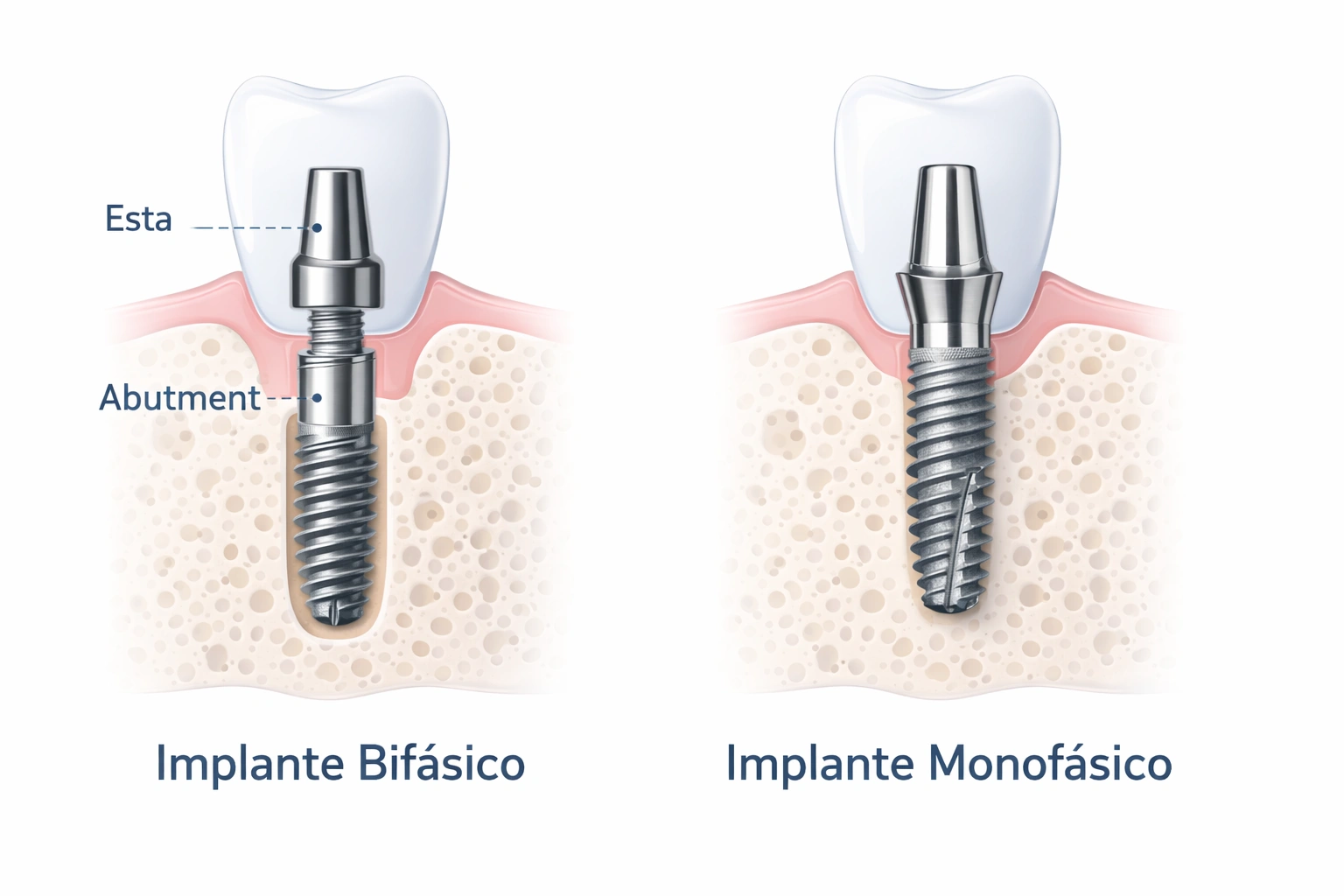 Comparación implante dental monofásico vs bifásico - diferencias técnicas y estructura