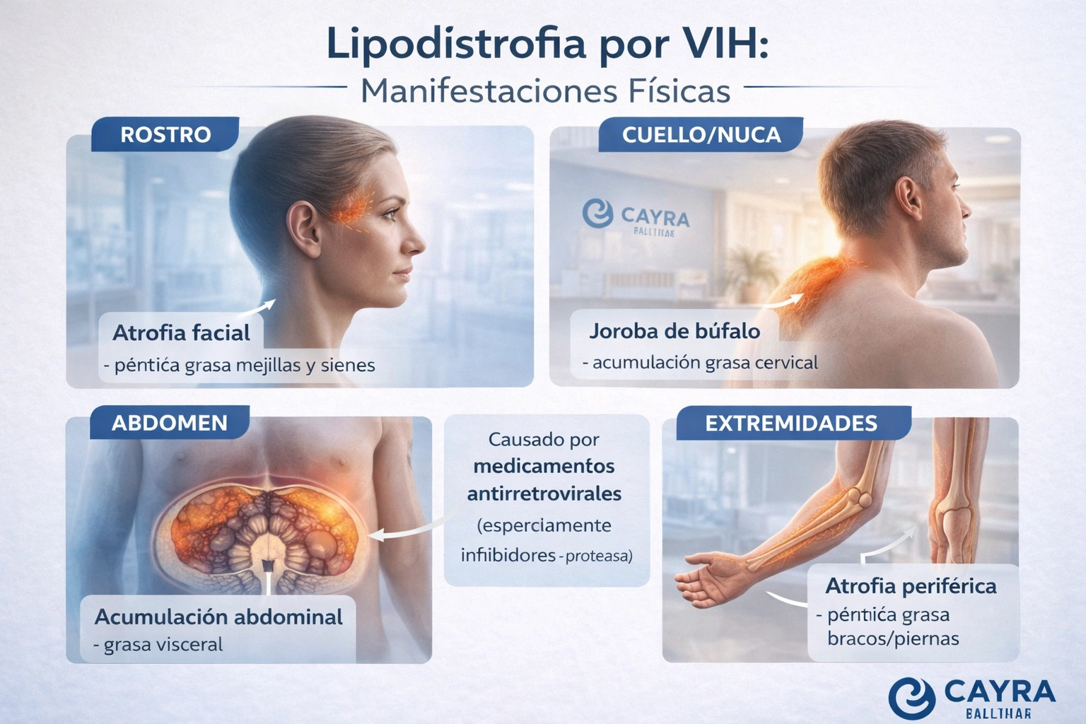 Manifestaciones lipodistrofia por VIH - atrofia facial, joroba de búfalo, acumulación abdominal causada por antirretrovirales