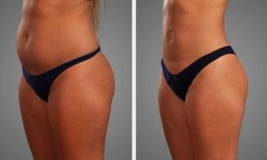 Abdominal y Lipo HD