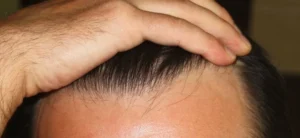 Cabello canoso y trasplante