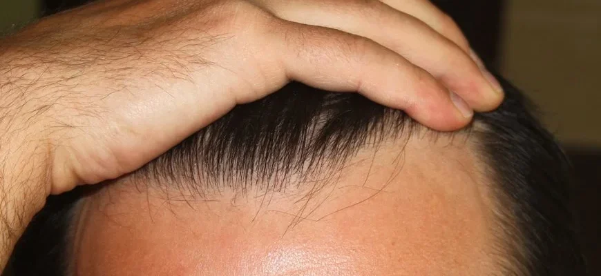 Cabello canoso y trasplante