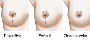 Mastopexia sin Implantes en Turquía Eleva tu Pecho Natural