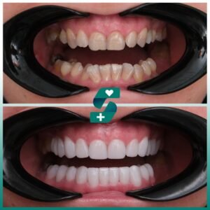 implantes cigomáticos en Turquía