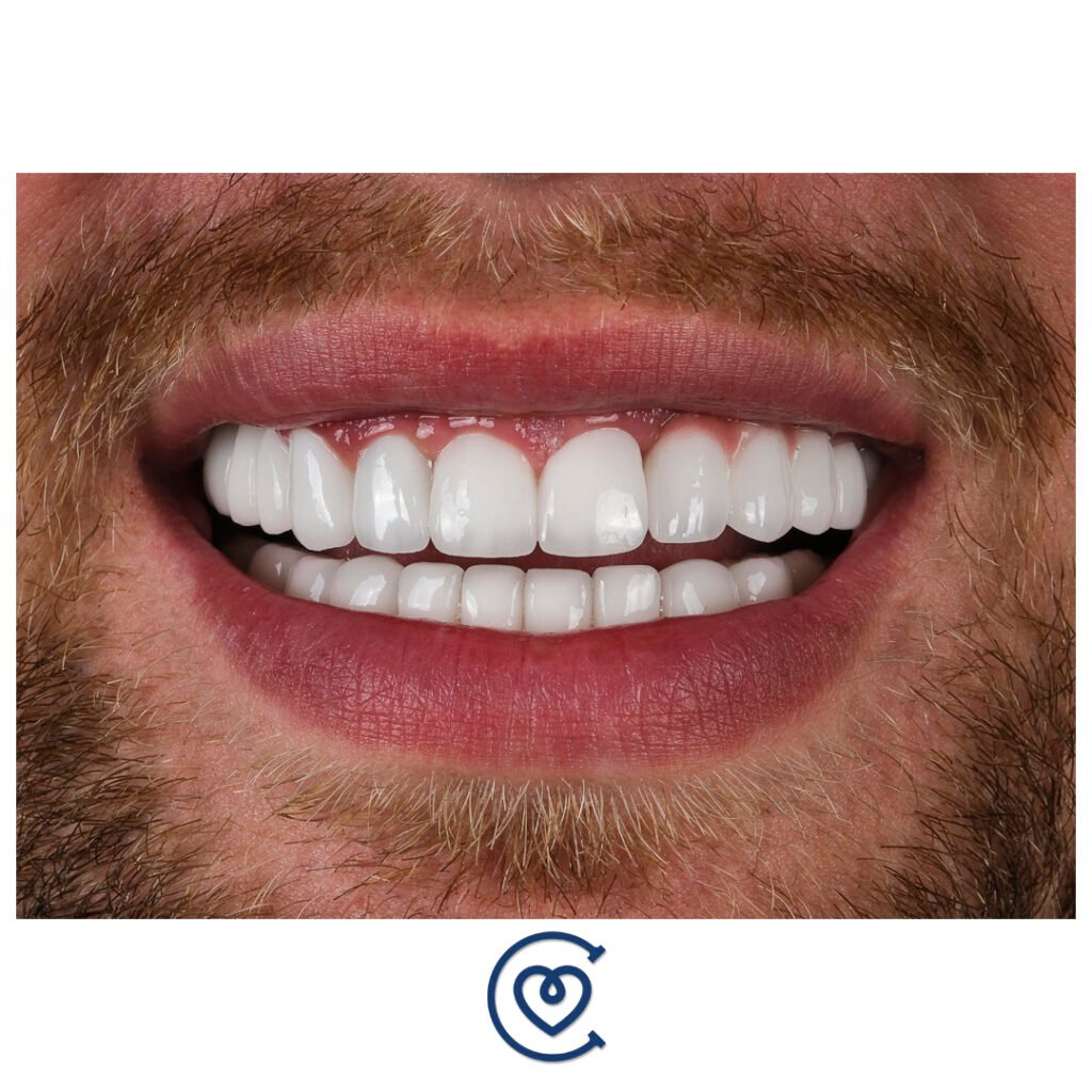 manchas en el esmalte dental en Antalya
