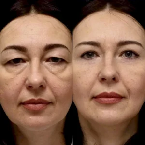 Blefaroespasmo en Turquía