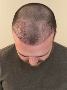 planificación para 5000 injertos en Estambul