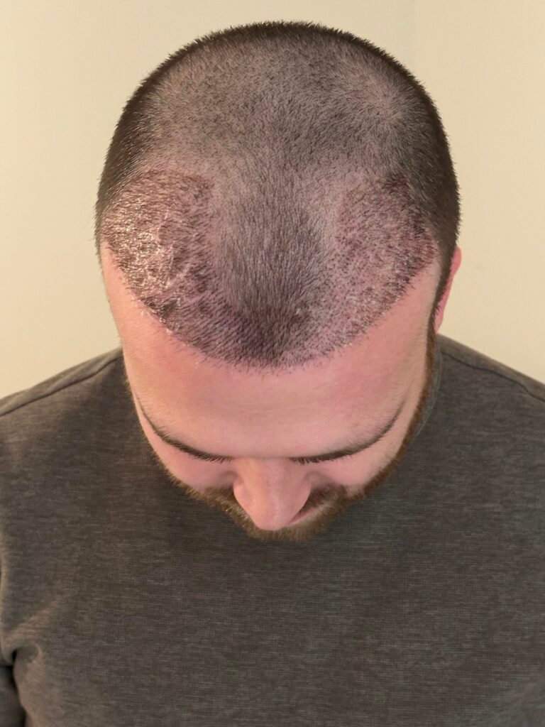 planificación para 5000 injertos en Estambul