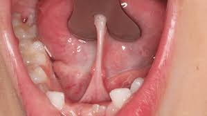 frenillo lingual en adultos