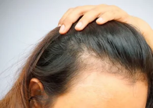 solucion_patologia_alopecia_frontal_fibrosante_imr