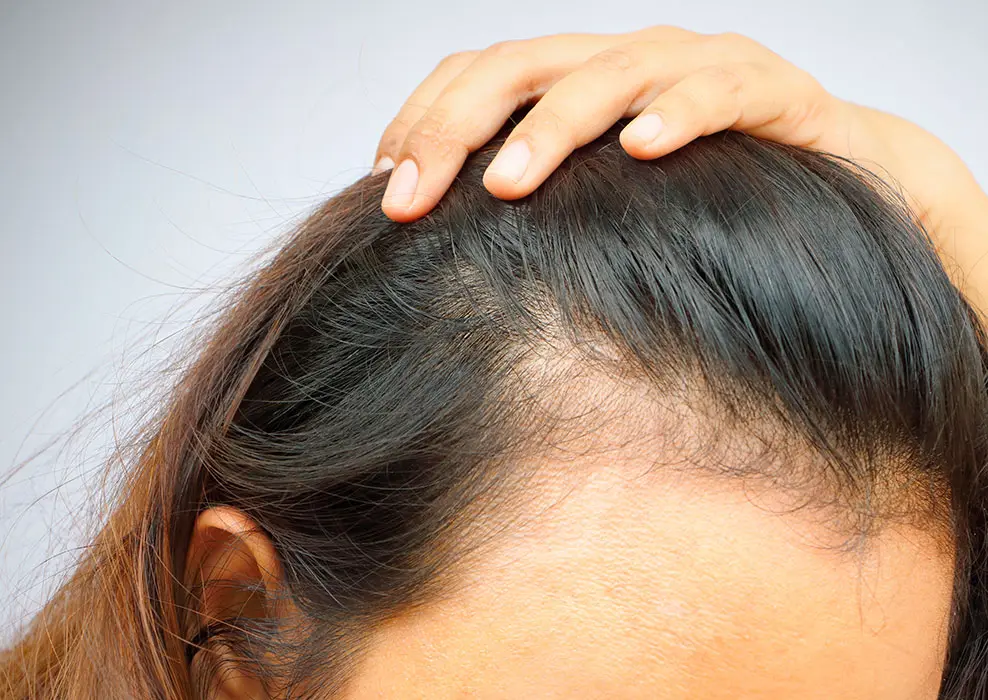 solucion_patologia_alopecia_frontal_fibrosante_imr