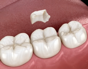 superiores a los empastes