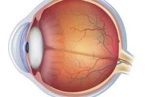 desprendimiento de retina en Turquía