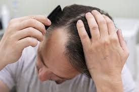 alopecia por tracción