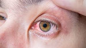 Dacriocistorrinostomía en Estambul