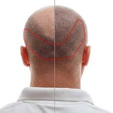 Longitud mínima del cabello