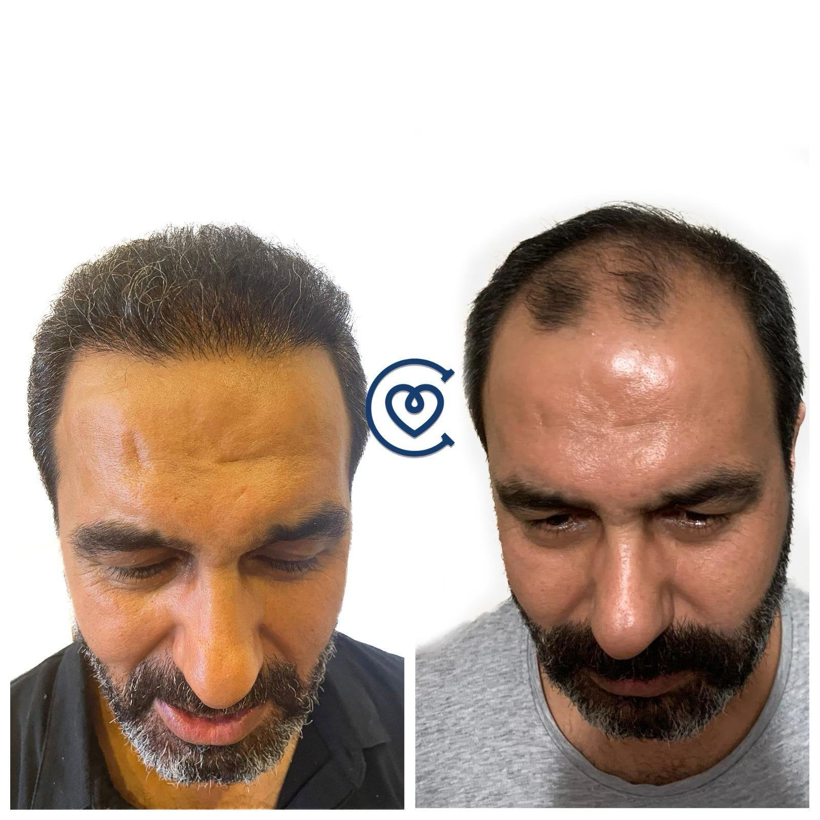 Consulta médica y diagnóstico en Cayra Clinic para la corrección y diseño de un injerto capilar previo con baja densidad.