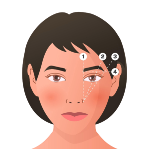 blefaroplastia barcelona