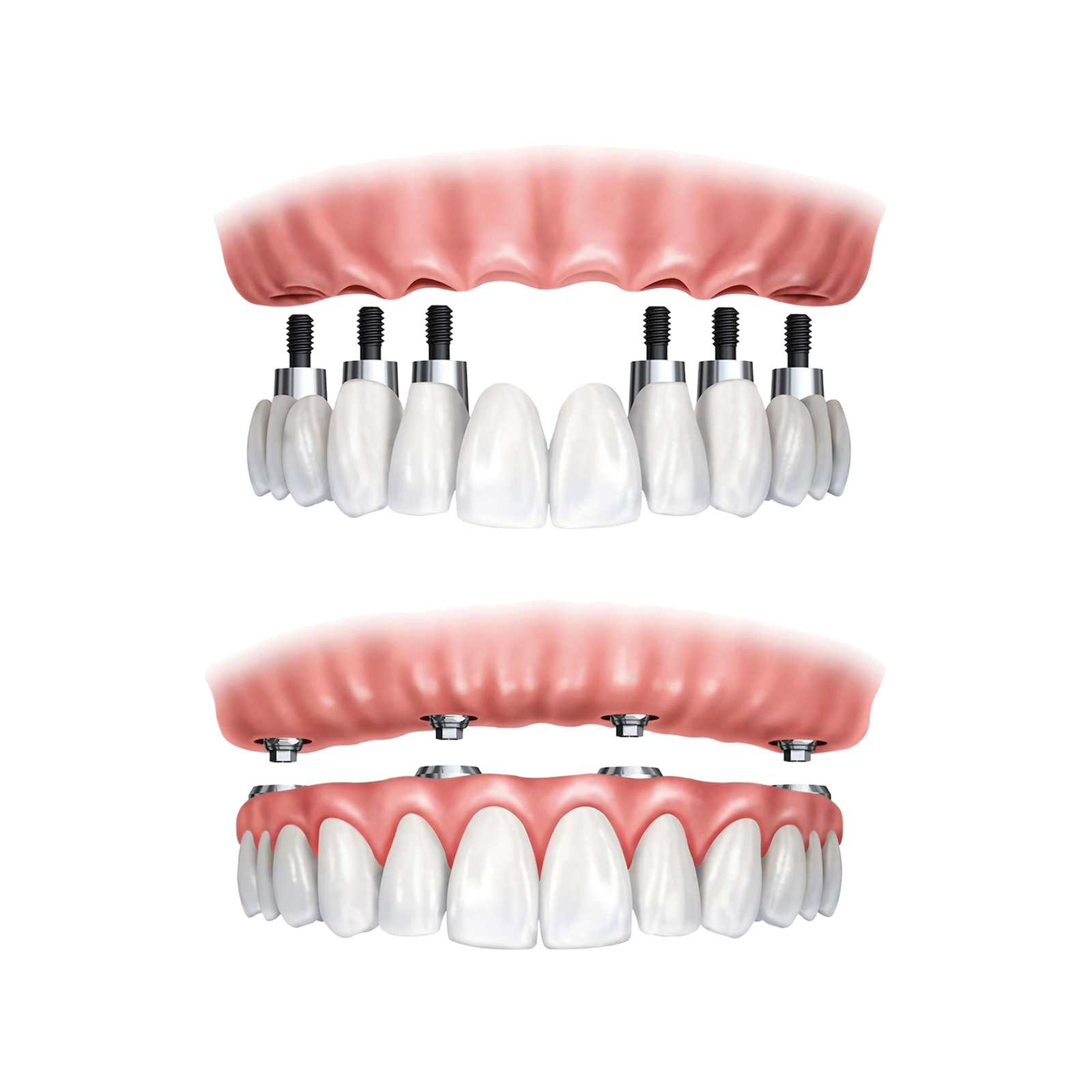 Implantes All-on-6