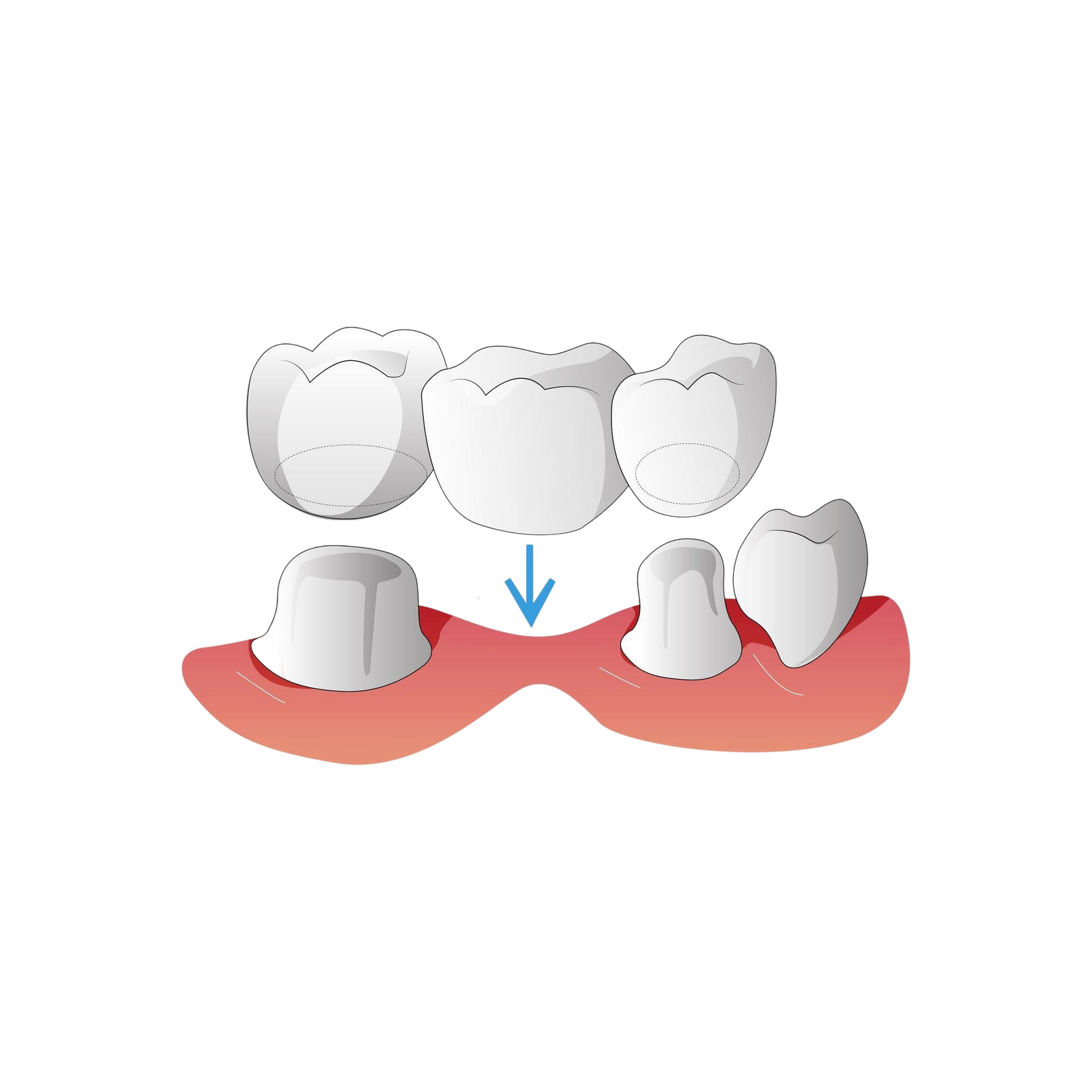 Puentes Dentales