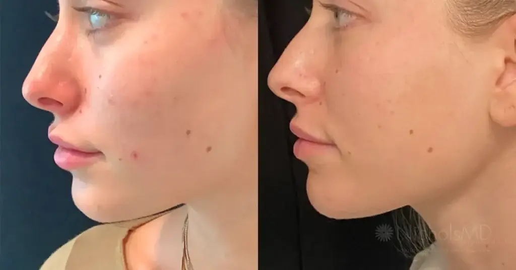 PRP para el rejuvenecimiento facial en Cayra Clinic Turquía