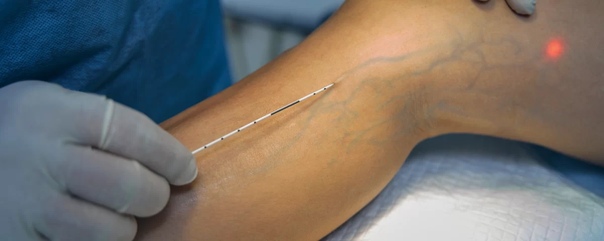 Procedimiento de ablacion laser endovenosa para tratamiento de vena safena en Estambul