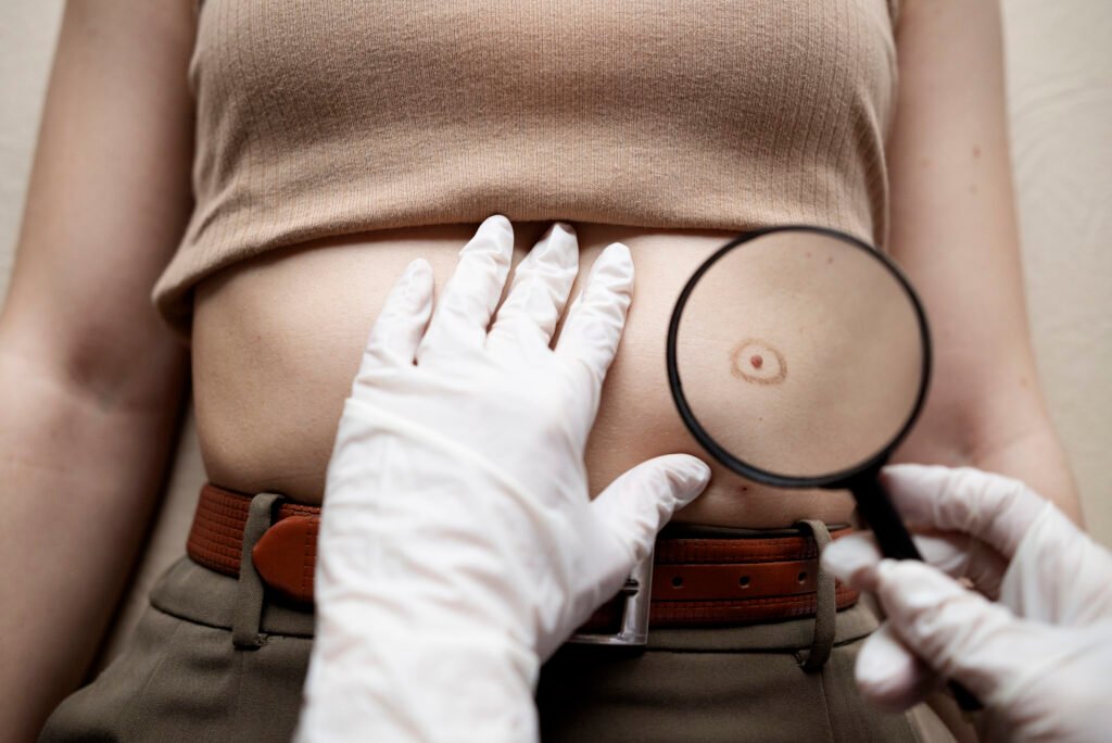 Cirugia menor de piel extirpacion rapida de lipomas y quistes en Turquia Cayra Clinic