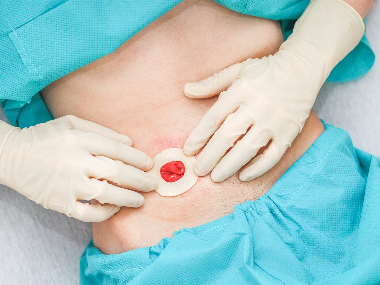 Extirpacion quirúrgica de lipoma y quiste sebaceo con sutura estetica en Estambul