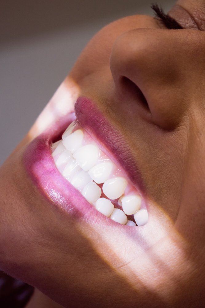 Blanqueamiento dental avanzado como parte del tratamiento Hollywood Smile.