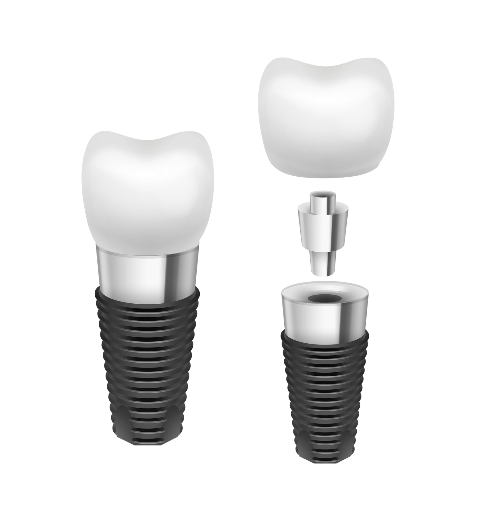 Imagen que muestra el tratamiento All‑on‑6 en Turquía, destacando el precio y la calidad del procedimiento dental.