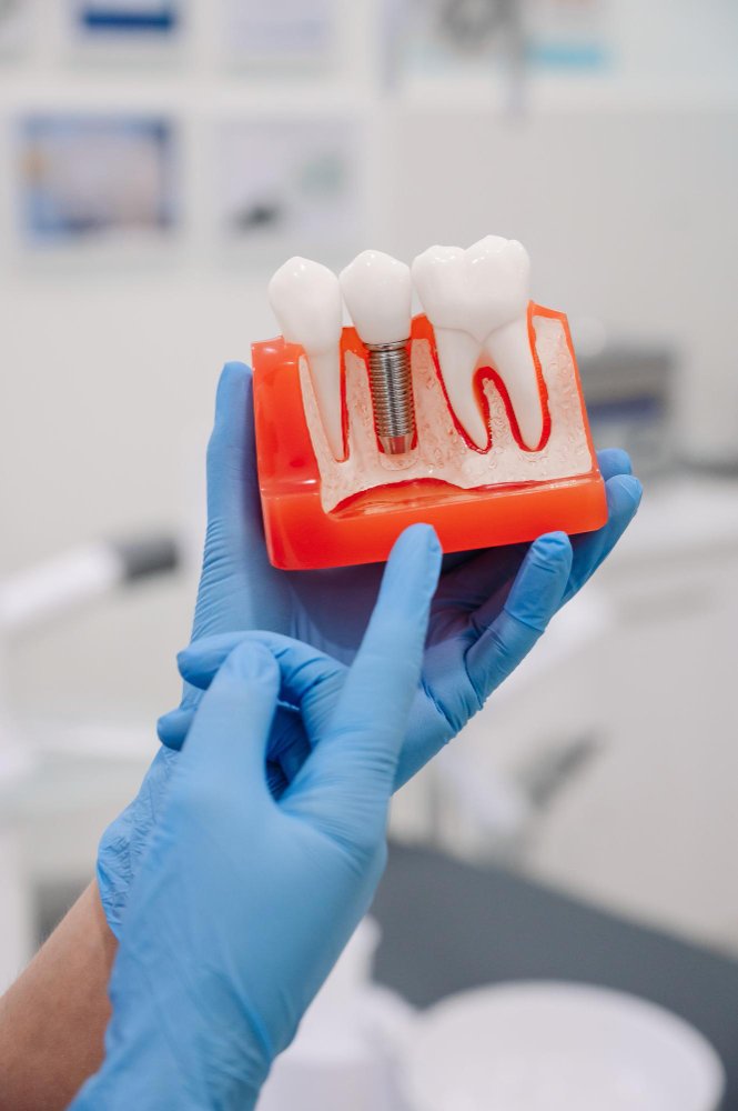 Precios de implantes dentales en Turquía comparados con España y Alemania.