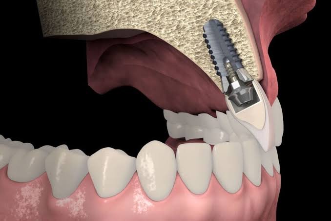 Injerto de tejido conectivo y tratamiento de recesion gingival en Estambul
