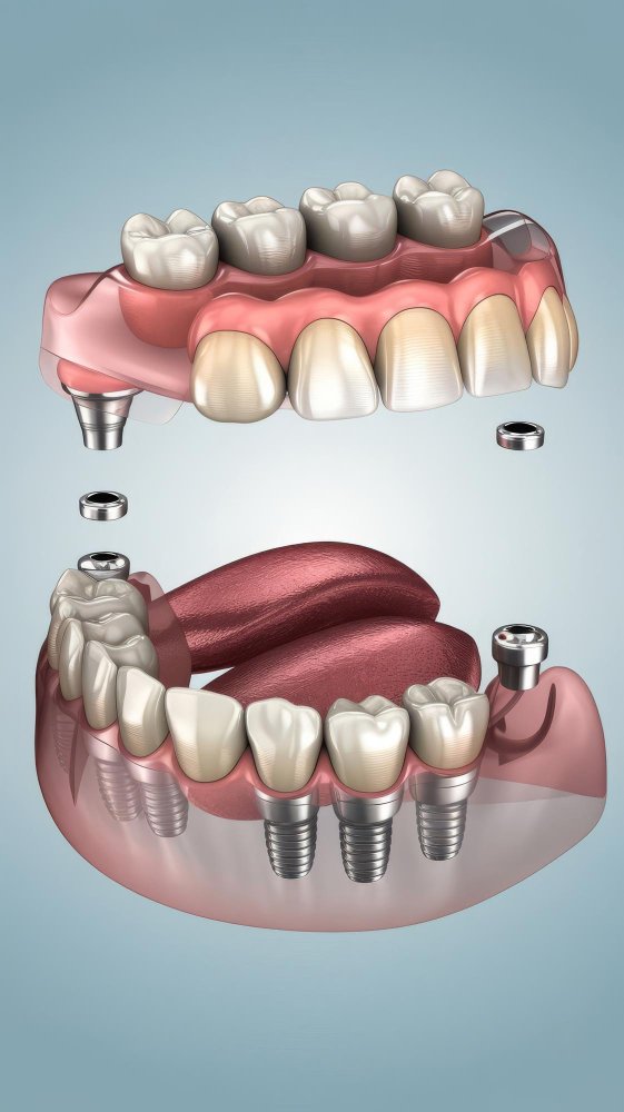 Imagen de paciente con tratamiento All‑on‑6, mostrando el cambio antes y después con una sonrisa renovada.