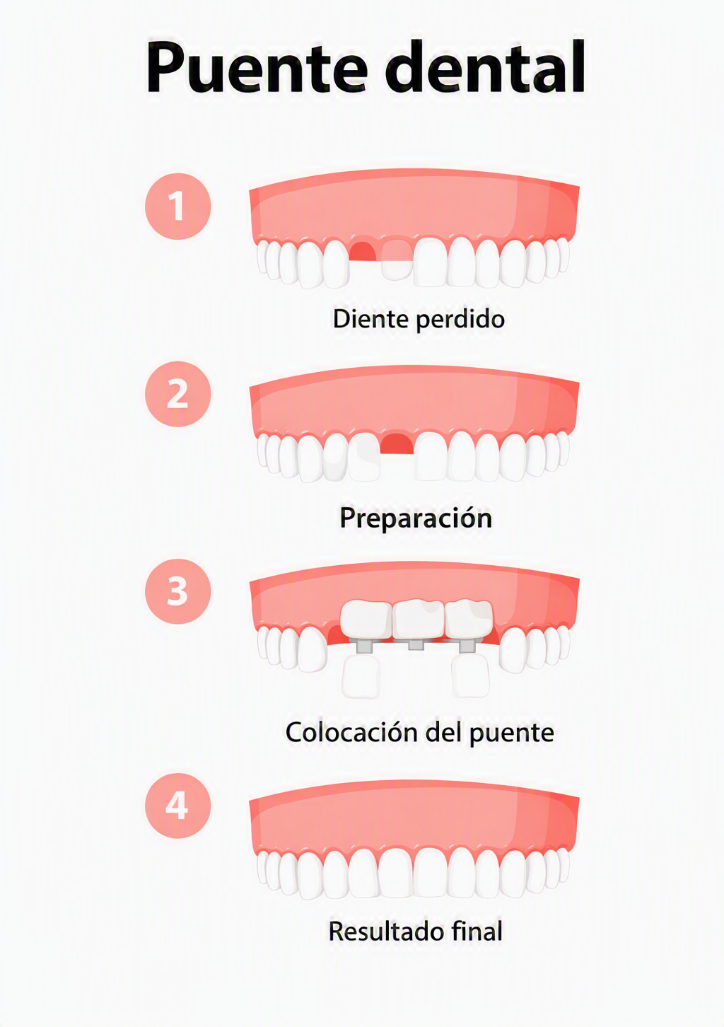 Infografía vertical que muestra los 4 pasos del puente dental: diente perdido, preparación, colocación y resultado final.